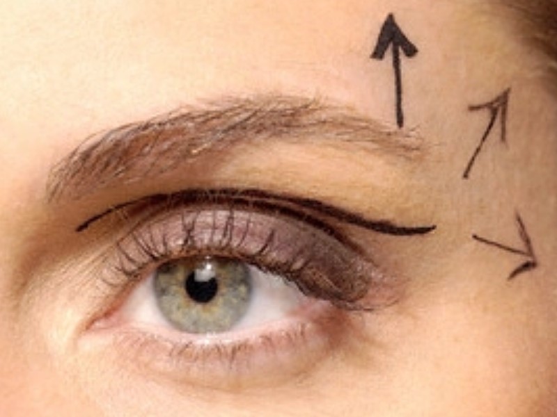 Preden se odločite za operacijo povešenih vek, se prepričajte o razlogih, zakaj želite operacijo vek. Ne pozabite na stroške, tveganja in dejstvo, da rezultatov ni mogoče zagotoviti.