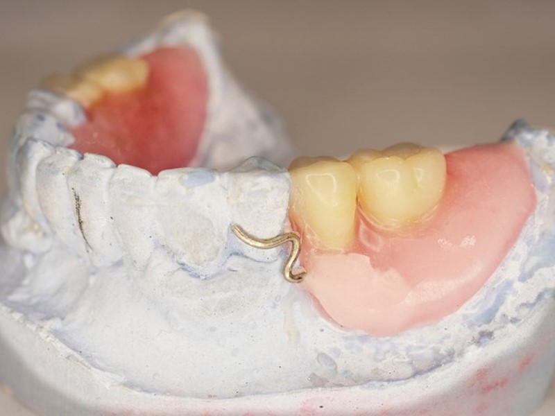 umetni zobje na mostičku