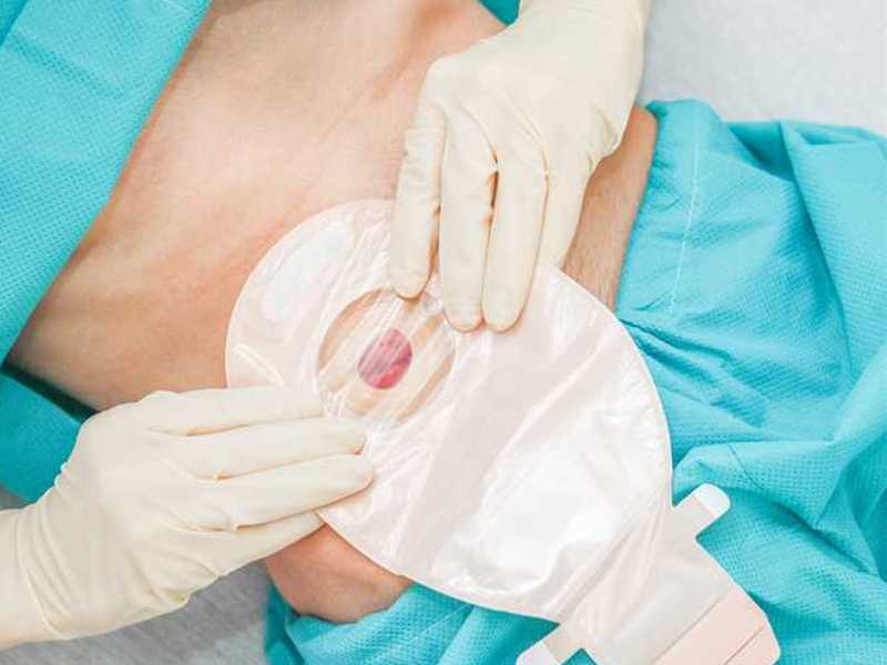 stoma pripomočki v spletni trgovini
